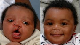 cleft_lip_beforeafter331